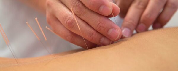 acupuncture