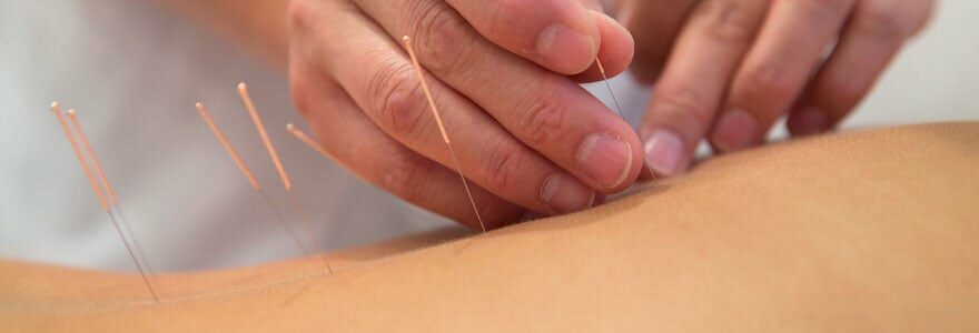 acupuncture